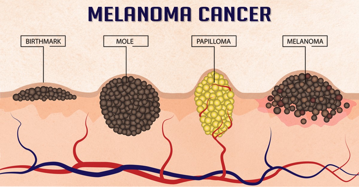Melanoma Cancer (skin cancer) Symptoms, Causes and Treatment
