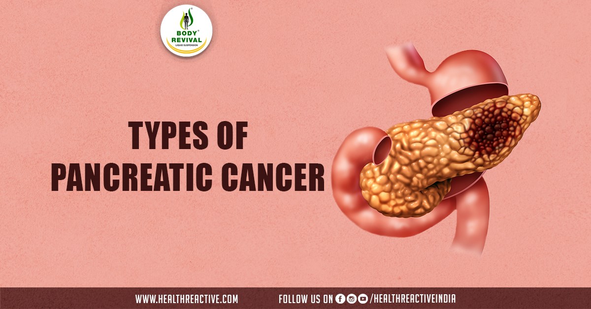 Unraveling the Complexity: Exploring the Types of Pancreatic Cancer