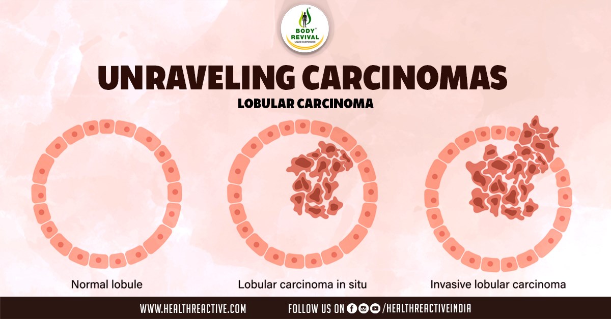 Understanding the Most Common Type of Cancer
