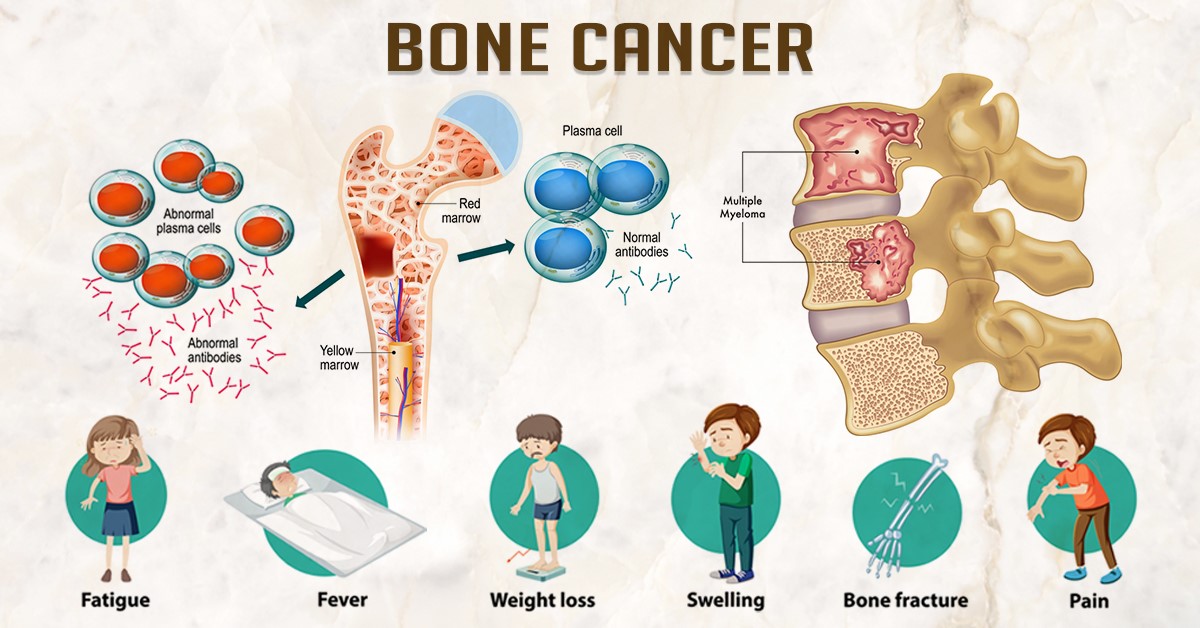 Bone Cancer Symptoms Causes And Treatment Health Reactive Body