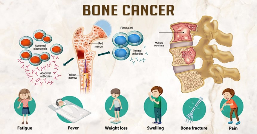 Bone Cancer- Symptoms, causes, and treatment.