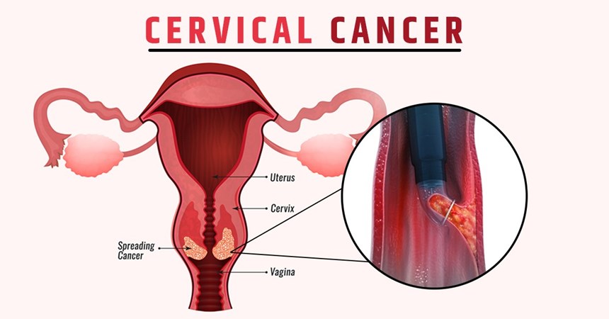 Cervical Cancer treatment