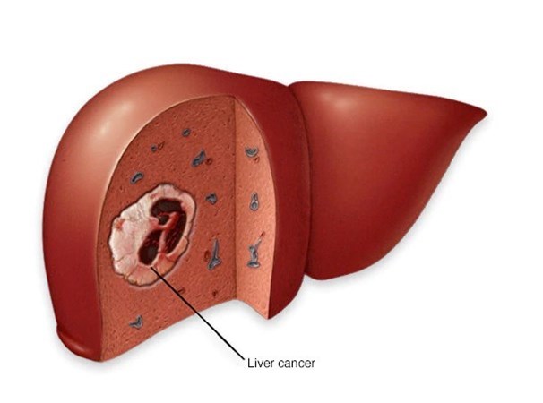 Liver cancer Ayurvedic Treatment