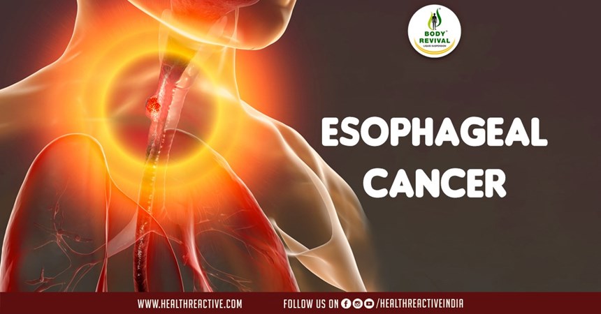 Understanding Esophageal Cancer: Causes, Symptoms, and Treatment Options