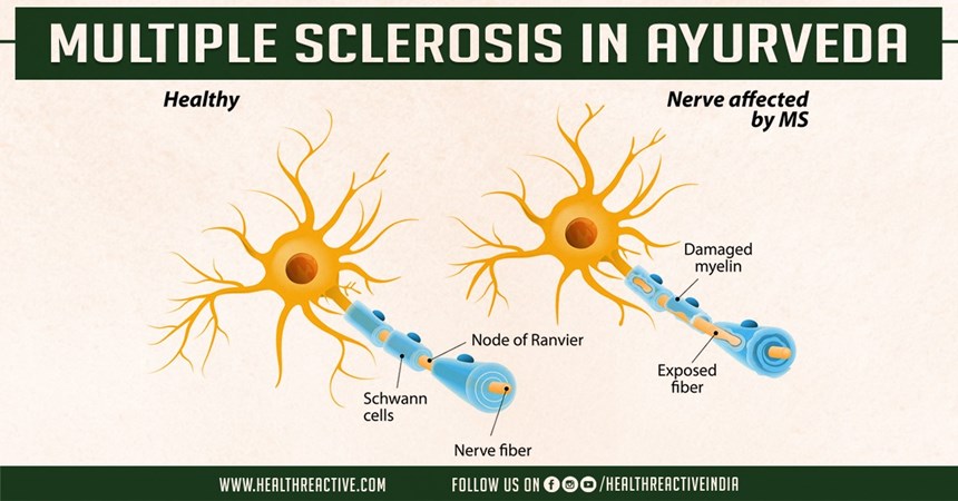 Multiple sclerosis in Ayurveda
