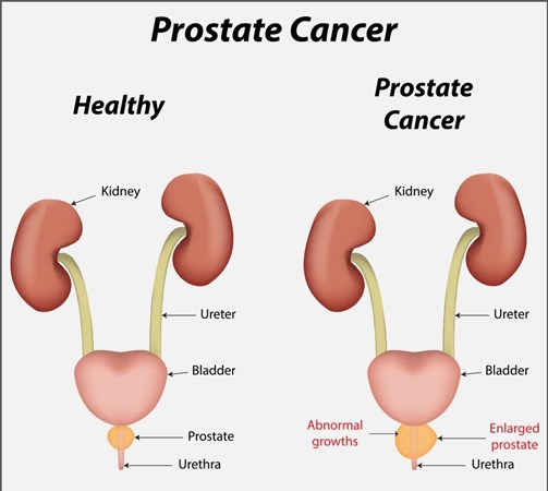 Prostatecancer before after