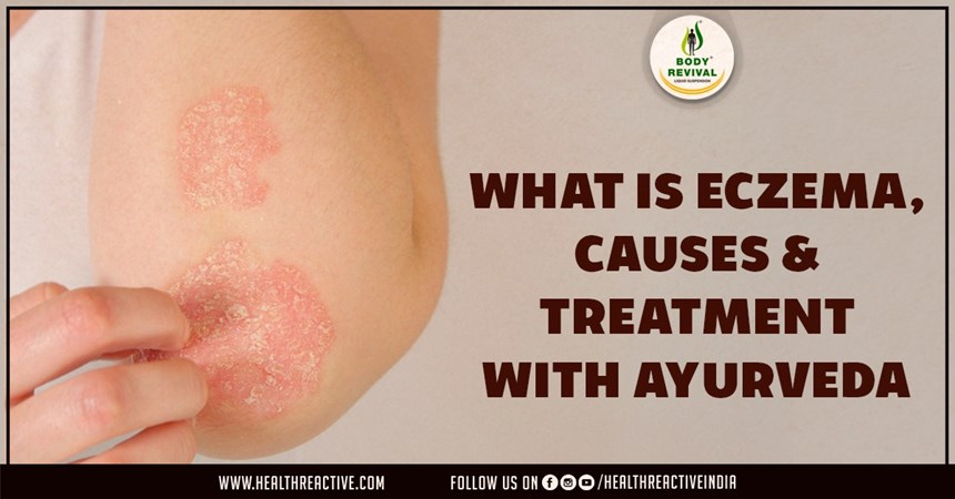What Is Eczema, Causes & Treatment With Ayurveda
